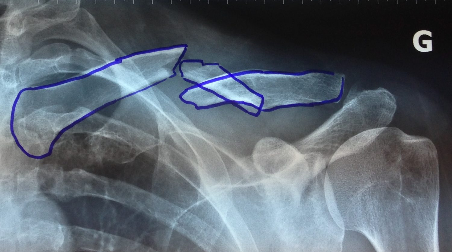 Fractures epaulevar — free download