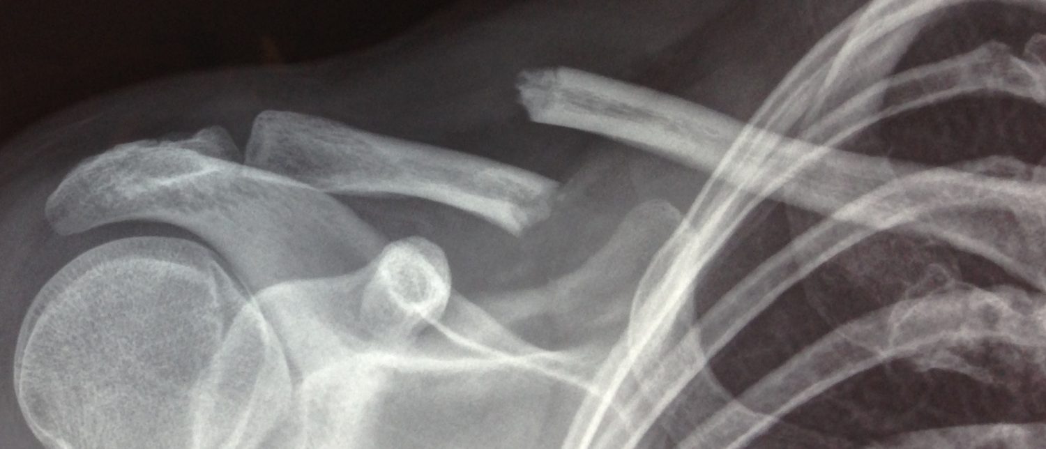 Fractures epaulevar — free download