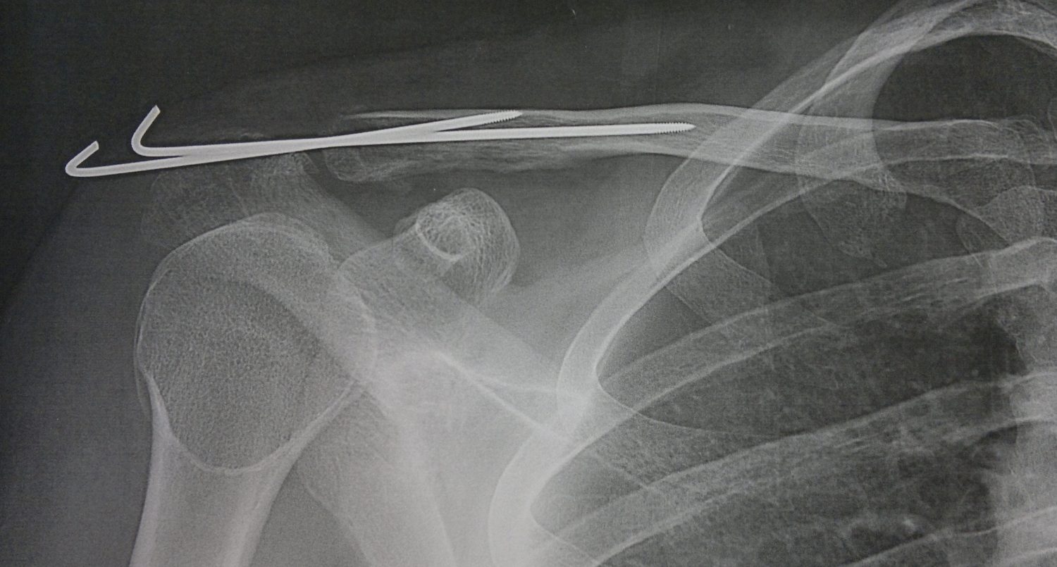 Fractures epaulevar