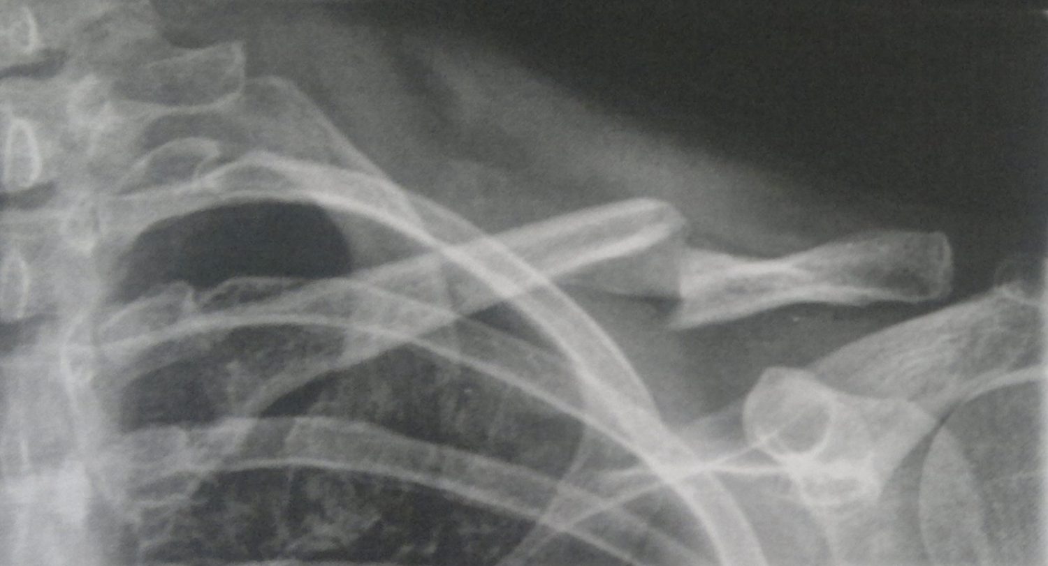 Fractures Dr Charles Bessiere Epaule Var — free download