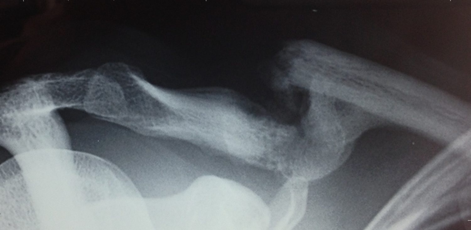 Fractures Dr Charles Bessiere Epaule Var — free download